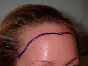 hairline advancement - patient 12 - before 2