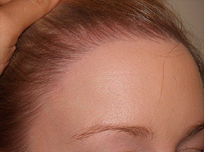 hairline advancement - patient 12 - after 4