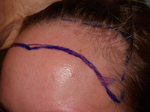 hairline advancement - patient 12 - before 4