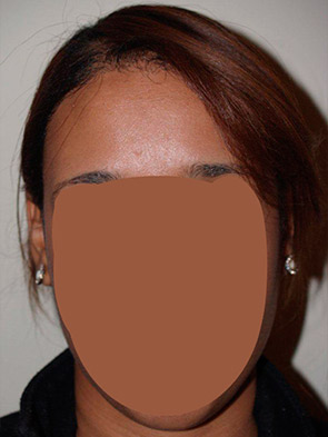 hairline advancement - patient 40 - after 1