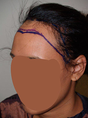 hairline advancement - patient 40 - before 2
