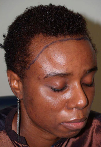 hairline advancement - patient 8 - before 2