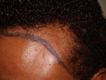 hairline advancement - patient 8 - before 5