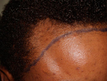 hairline advancement - patient 8 - before 4