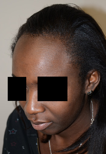 hairline advancement - patient 43 - before 2