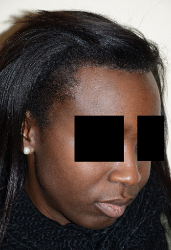 hairline advancement - patient 43 - after 3