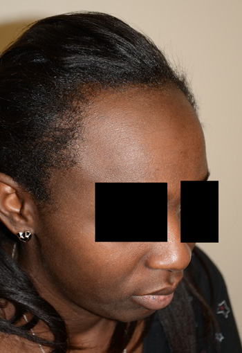 hairline advancement - patient 43 - before 3