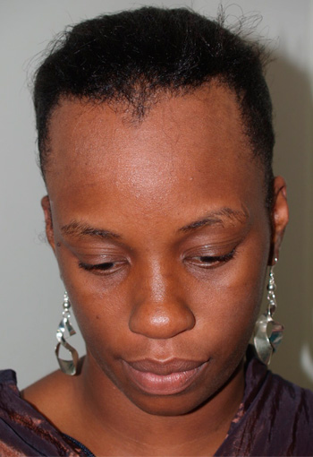 hairline advancement - patient 44 - before 1
