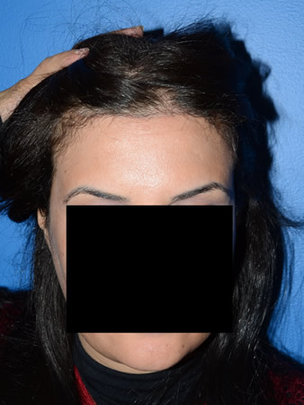 hairline advancement - patient 28 - after 1