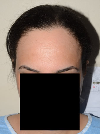 hairline advancement - patient 28 - before 1