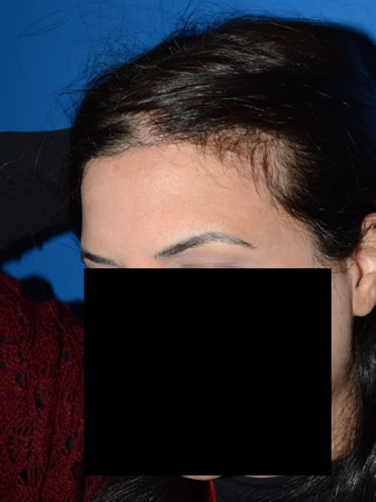 hairline advancement - patient 28 - after 2