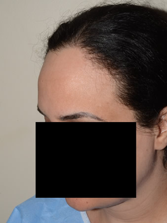 hairline advancement - patient 28 - before 2
