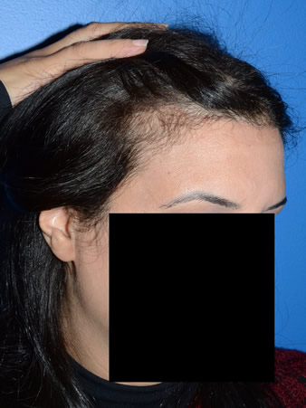 hairline advancement - patient 28 - after 3