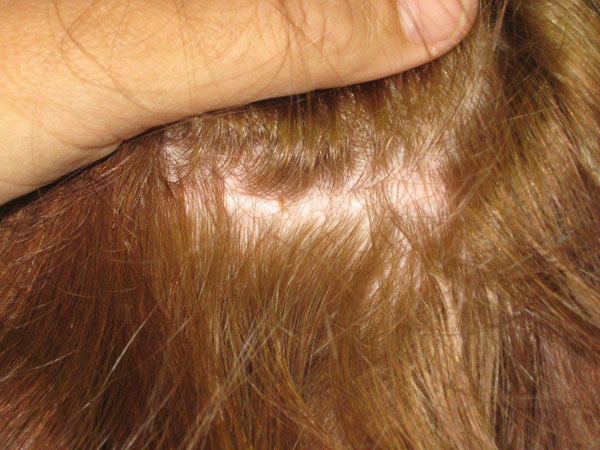 hairline advancement - patient 20 - after 4
