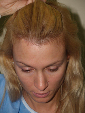 hairline advancement - patient 22 - after 2