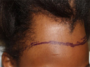 hairline advancement - patient 24 - before 3