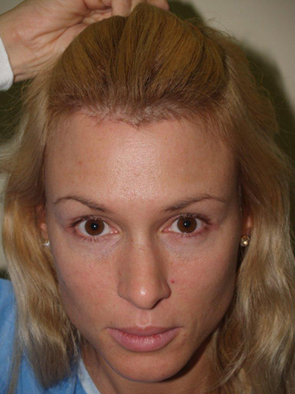 hairline advancement - patient 22 - after 1