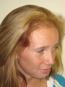 Miami, Fl Hairline Advancement Photo - Patient 1 - After 2