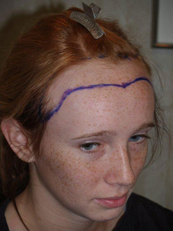 hairline advancement - patient 20 - before 2