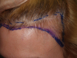 hairline advancement - patient 22 - before 6