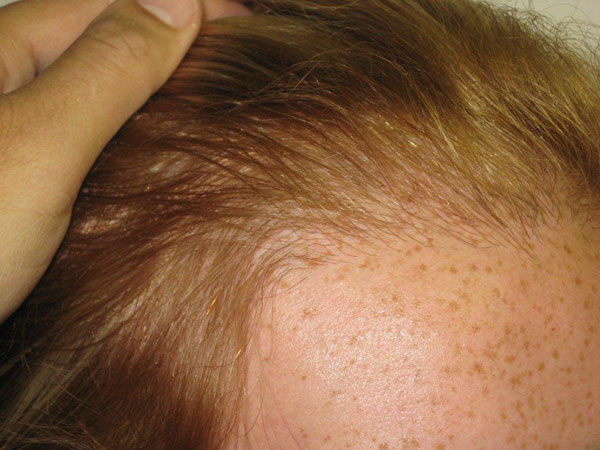 hairline advancement - patient 20 - after 3