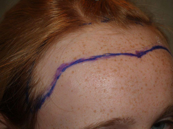 hairline advancement - patient 20 - before 3