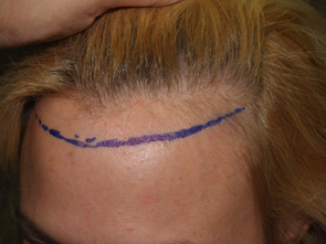 hairline advancement - patient 22 - before 5