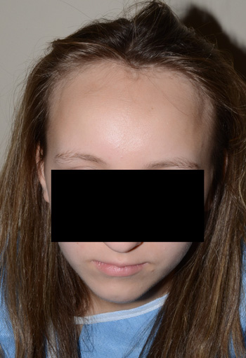 hairline advancement - patient 19 - before 1