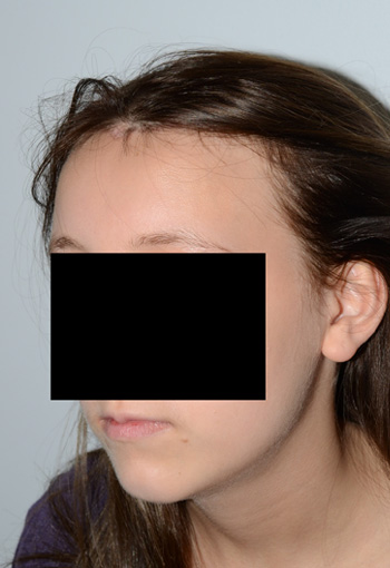 hairline advancement - patient 19 - after 3