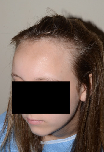 hairline advancement - patient 19 - before 3
