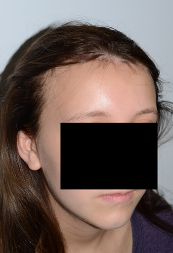 hairline advancement - patient 19 - after 2