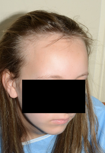 hairline advancement - patient 19 - before 2