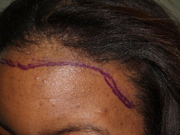 hairline advancement - patient 13 - before 6