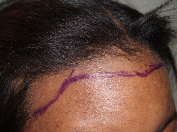 hairline advancement - patient 13 - before 5