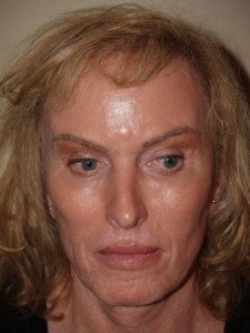 Miami, Fl. Transgender Photo - Patient 1 - After 1