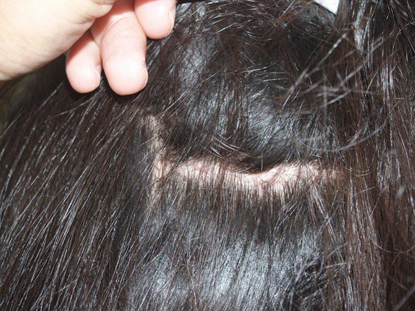 hairline advancement - patient 14 - after 4