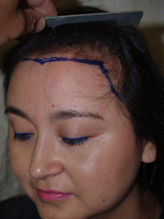 hairline advancement - patient 14 - before 3