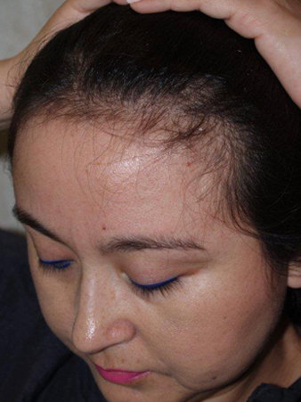 hairline advancement - patient 14 - before 2