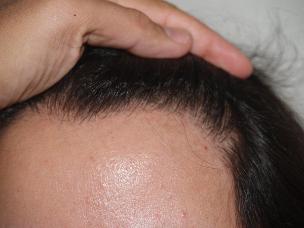 hairline advancement - patient 14 - after 3