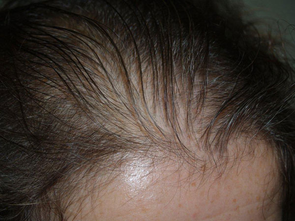 follicular unit micrografting - patient 8 - before 2