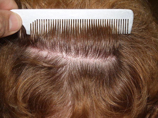 hairline advancement - patient 17 - after 7