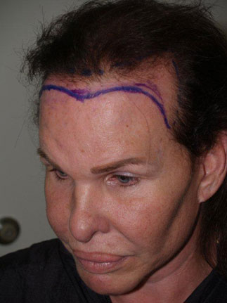 hairline advancement - patient 17 - before marked 3