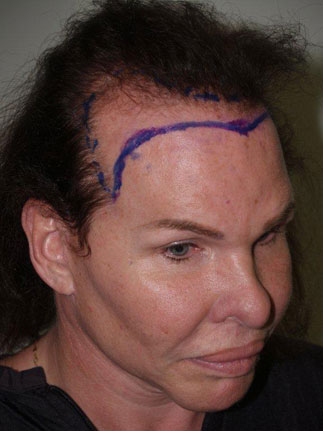 hairline advancement - patient 17 - before marked 2