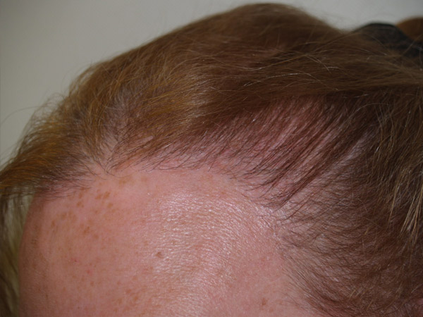 hairline advancement - patient 17 - after 6