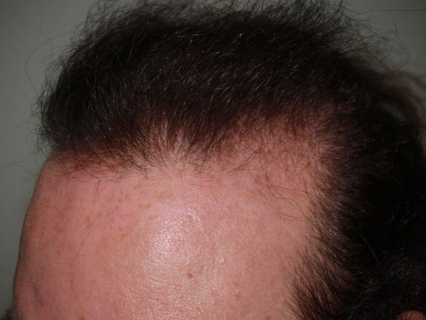 hairline advancement - patient 17 - before 6