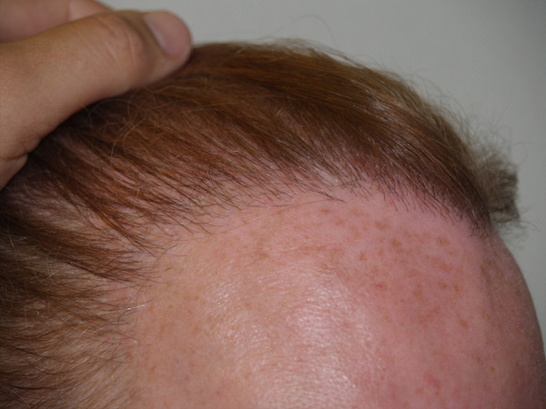 hairline advancement - patient 17 - after 5