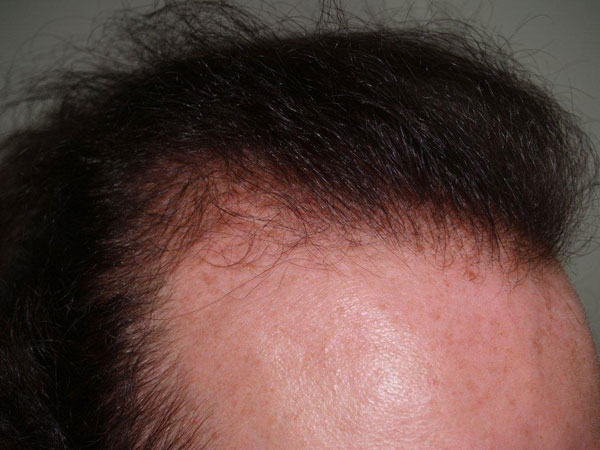 hairline advancement - patient 17 - before 5