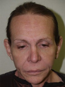 Miami, Fl Transgender Photo - Patient 1 - Before 1