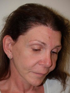 Miami, Fl Transgender Photo - Patient 1 - After 2