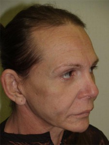 Miami, Fl Transgender Photo - Patient 1 - Before 2